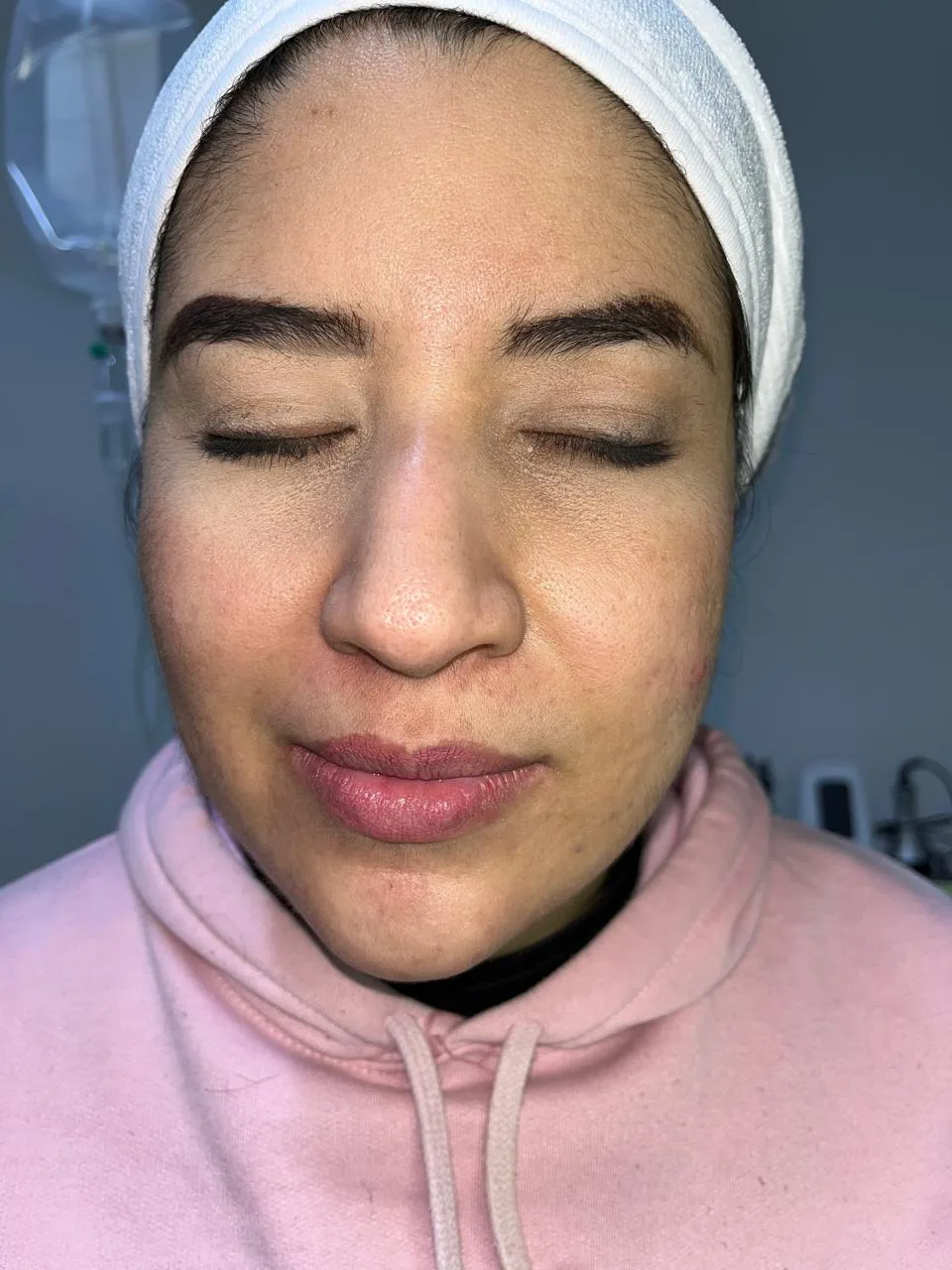 Antes del tratamiento — resultado real 6, Klass Salón & Spa