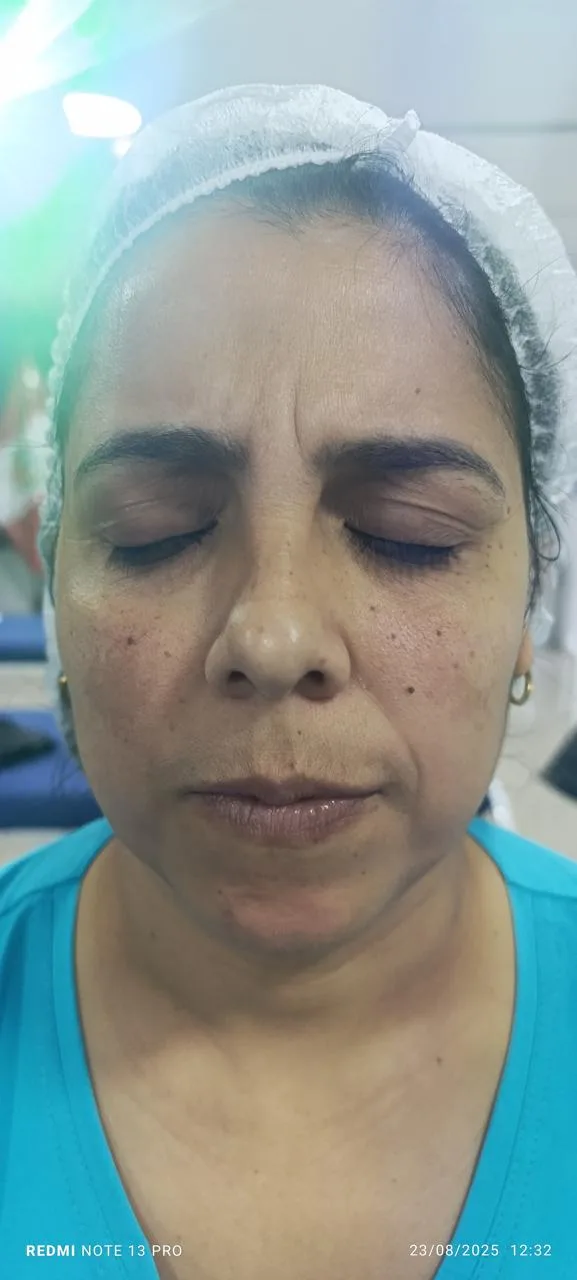 Antes del tratamiento — resultado real 7, Klass Salón & Spa