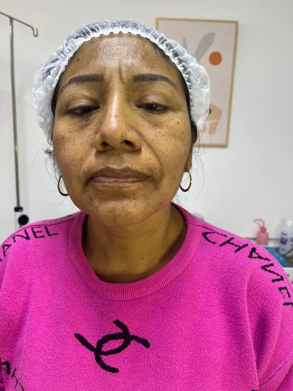 Antes del tratamiento — resultado real 9, Klass Salón & Spa