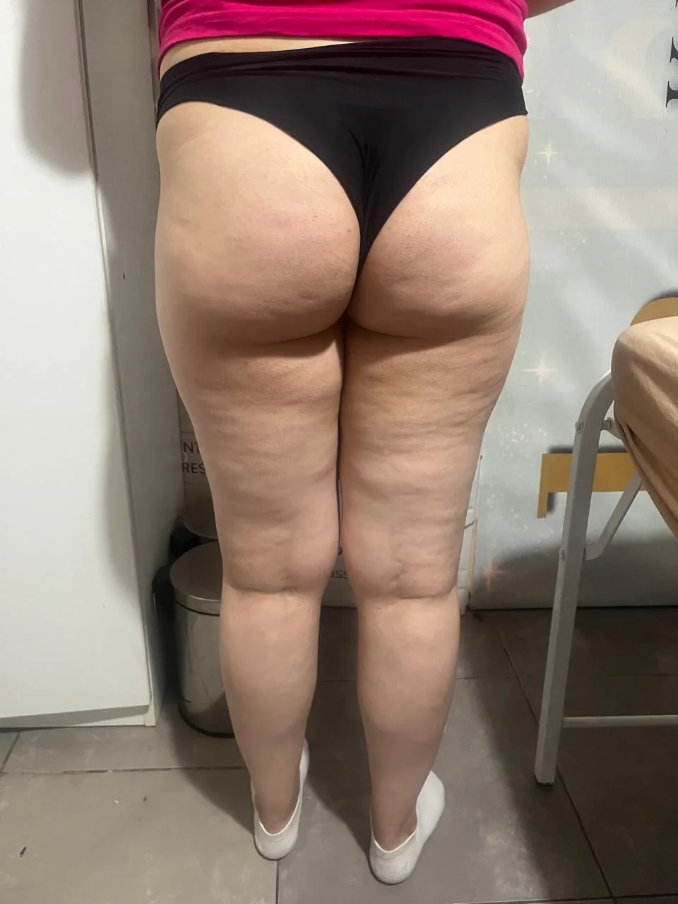 Tratamiento Anticelulítico en Klass Salón & Spa